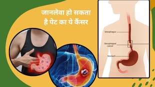 stomach cancer,cancer, gastric cancer symptoms, India gastric cancer cases, prevent stomach cancer, signs of stomach cancer,
