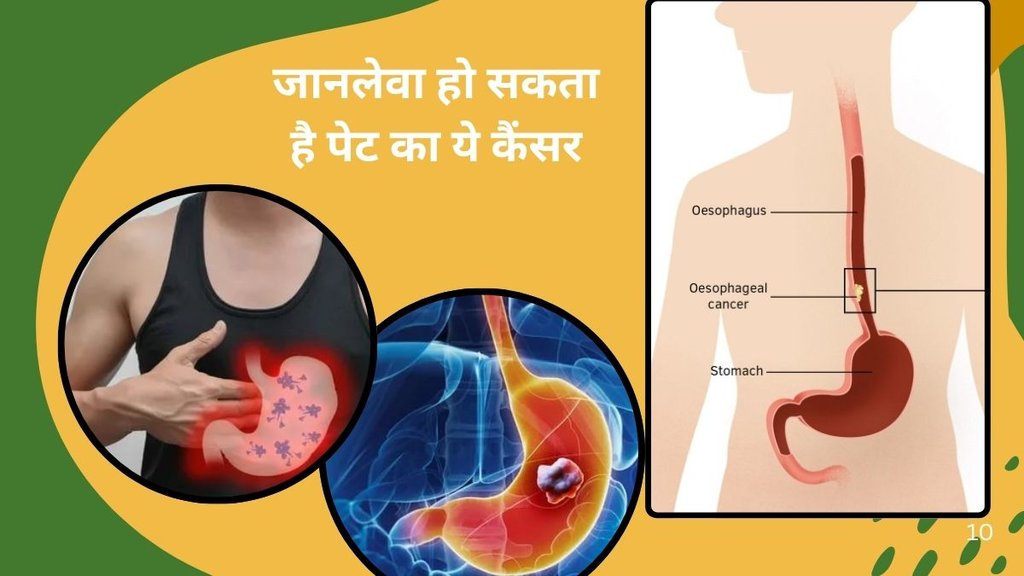 stomach cancer,cancer, gastric cancer symptoms, India gastric cancer cases, prevent stomach cancer, signs of stomach cancer,