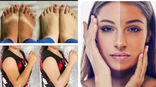 Sun tanning home remedies for face | How to remove tan from face immediately | sun tanning kaise hataye