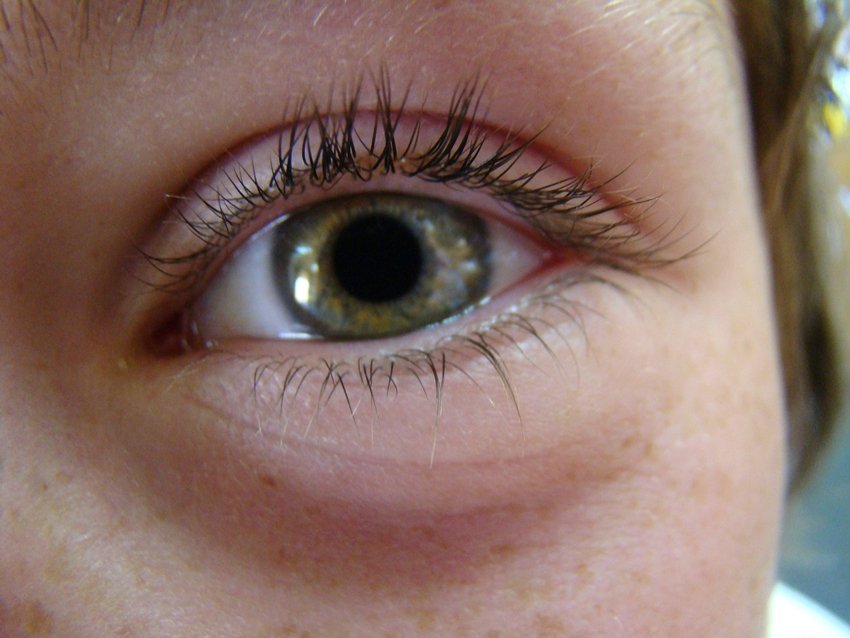swelling around the eyes