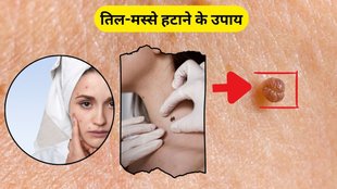 moles, Masse, Moles on skin, warts home remedies, Til Or Masse, masse hatane ke gharelu upay, masse hatane ke upay, How To Get Rid Of Warts Naturally, How To Remove Warts, how to remove moles
