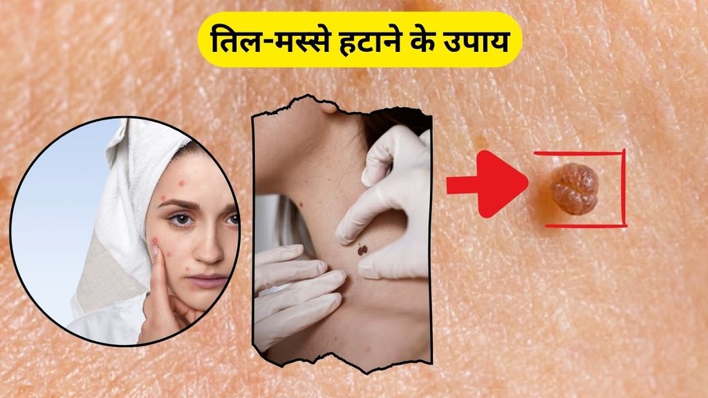 moles, Masse, Moles on skin, warts home remedies, Til Or Masse, masse hatane ke gharelu upay, masse hatane ke upay, How To Get Rid Of Warts Naturally, How To Remove Warts, how to remove moles