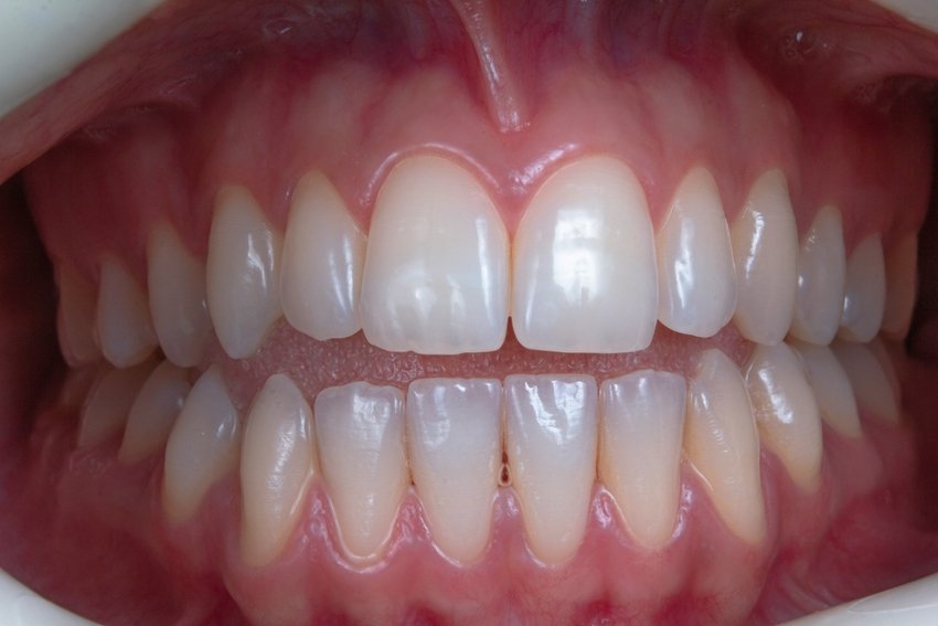 Acharya Balkrishna dental remedy