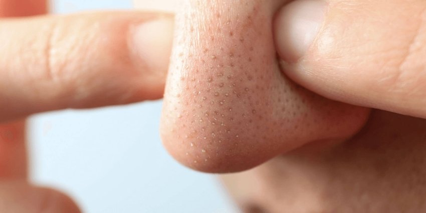 Best Remedies to Remove Blackheads Naturally