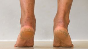 Cracked heels home care