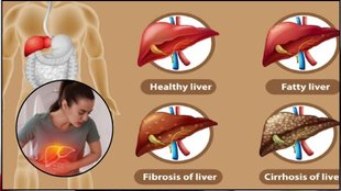 non alcoholic fatty liver disease, NAFLD, liver disease, how to cure nafld, fatty liver, cirrhosis, alcoholic fatty liver disease