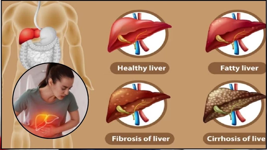 non alcoholic fatty liver disease, NAFLD, liver disease, how to cure nafld, fatty liver, cirrhosis, alcoholic fatty liver disease