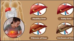 Fatty Liver Disease: अल्कोहलिक या नॉन-अल्कोहलिक, कौन सा फैटी लिवर ज्यादा खतरनाक है? जानें लक्षण और बचाव