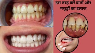 Periodontitis symptoms,Pyorrhea treatment, Gum disease remedies, Natural toothpaste for gum disease, Herbal toothpaste for pyorrhea,