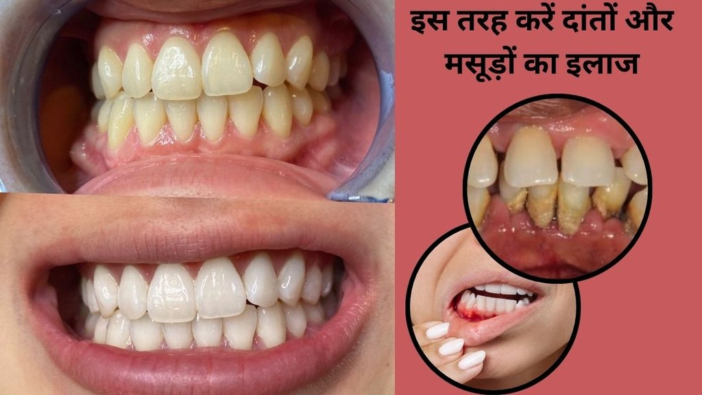 Periodontitis symptoms,Pyorrhea treatment, Gum disease remedies, Natural toothpaste for gum disease, Herbal toothpaste for pyorrhea,