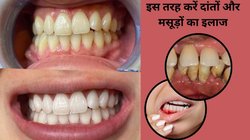मसूड़ों से खून, सूजन और रेडनेस पायरिया के हो सकते हैं लक्षण, लेकिन एक करामाती मंजन करेगा सारे दुख दूर, आयुर्वेदिक डॉक्टर ने बताया नुस्खा