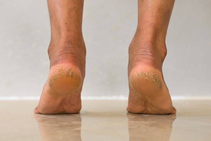 Iron Deficiency Could Be the Real Reason Behind Cracked Heels