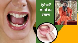 mouth ulcer, home remedies for mouth ulcer, mouth problem,yoga for mouth ulcer, swami ramdev fitness,मुंह के छाले के लिए घरेलू इलाज,Mouth ulcer home remedy, Ayurvedic treatment for ulcers, Acharya Balkrishna health tips, Natural cure for mouth sores
