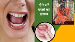 मुंह के छालों के कारण बोलने और खाने में हो रही दिक्कत? इस 1 तरीके से करें Ulcer कंट्रोल, बाबा रामदेव ने बताया एक दिन में अल्सर का इलाज