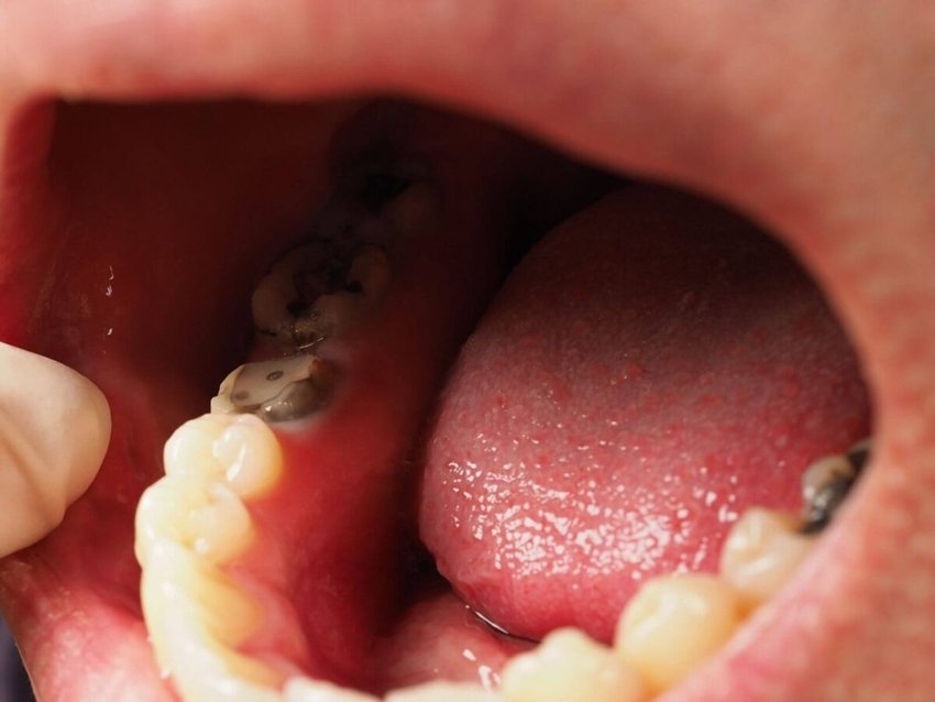 Neem Leaves to Fight Tooth Decay