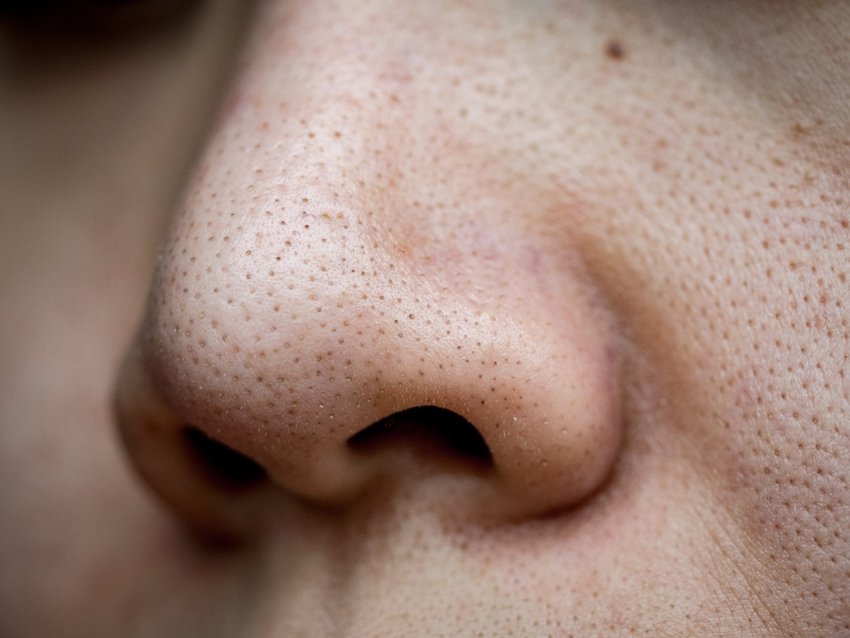 Remove Blackheads with Simple DIY Tips