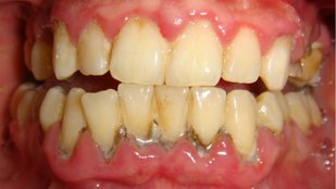 Say Goodbye to Yellow Teeth and Gum Problems with This Natural Powder