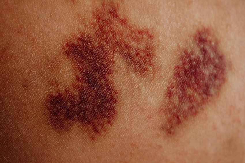 Signs of Protein Deficiency You Should Never Ignore