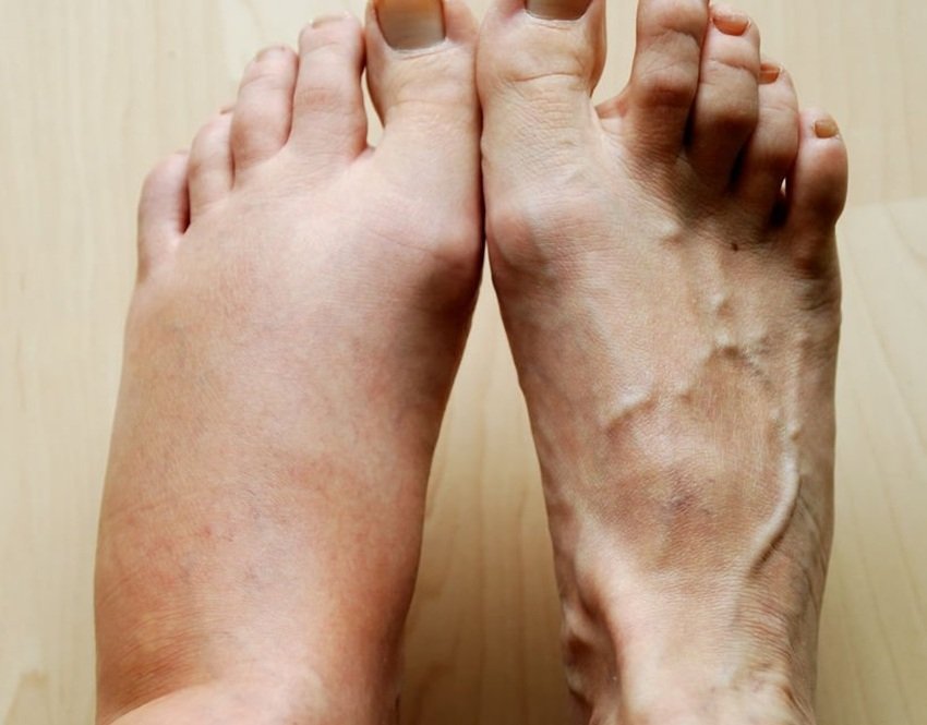 Comaprison of two legs one swollen