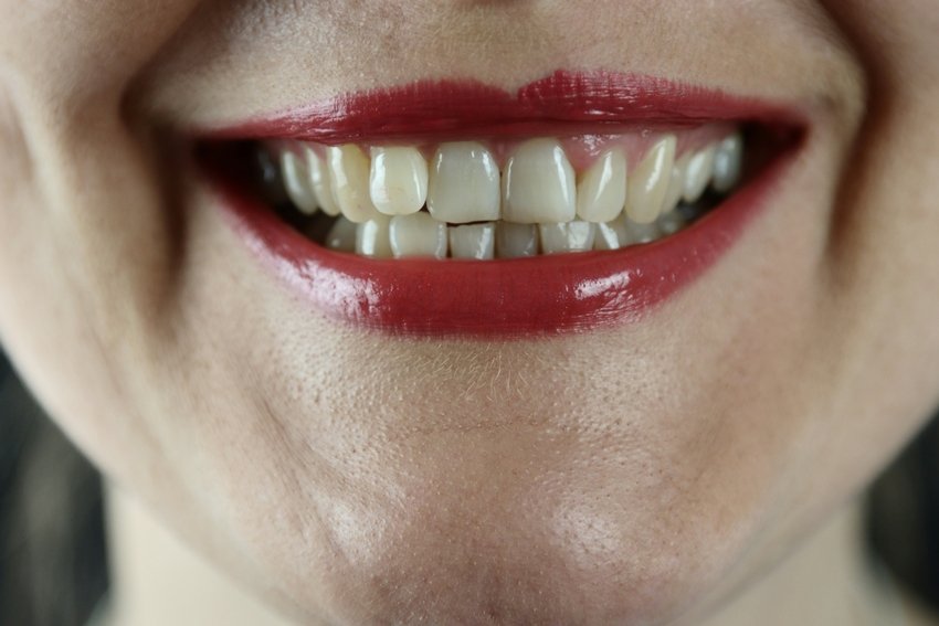 Tooth decay home remedy