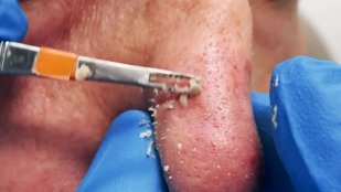 Easy Home Remedies to Remove Blackheads