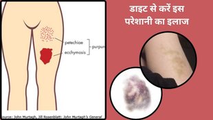 How to heal a bruise,What is the meaning of bruises,What are bruises caused by,What deficiency causes lots of bruising,Are bruises something to worry about