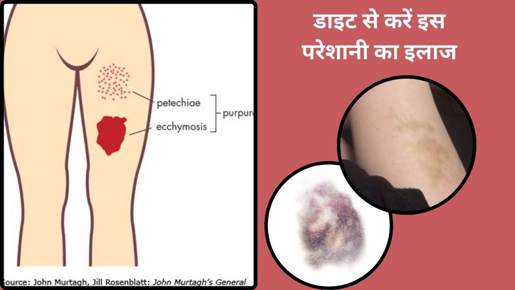 How to heal a bruise,What is the meaning of bruises,What are bruises caused by,What deficiency causes lots of bruising,Are bruises something to worry about