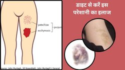 बिना चोट के जांघों और कमर पर नील क्यों पड़ते हैं? जानिए कारण और घर पर करें ये इलाज