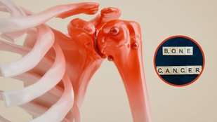 bone cancer early detection
