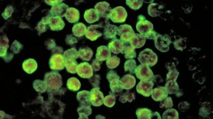 mebic encephalitis, deadly amoeba infection, amoeba infection,