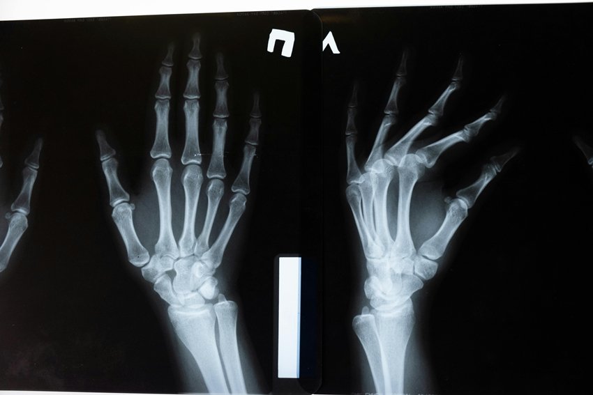 cancer related bone pain