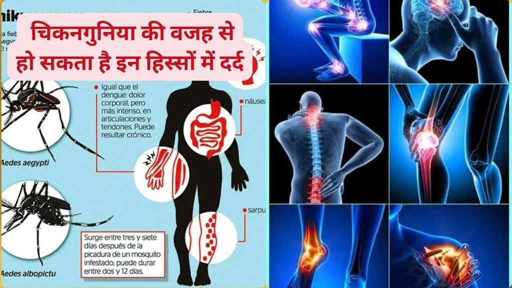 chikungunya fever, chikungunya causes, chikungunya symptoms, chikungunya treatment, chikungunya prevention tips, chikungunya diagnosis test, when to test for chikungunya, chikungunya RT-PCR vs ELISA test, how to detect chikungunya at home