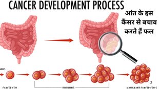 fruits to slash colon cancer risk,fruits that reduce colon cancer risk,fruit to eat to prevent colon cancer,colon cancer risks,