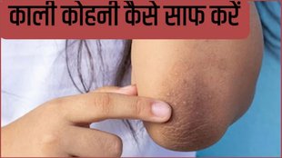 get rid of dark elbows, Black Kohni Kaise Saaf Kare, dark elbows home remedies