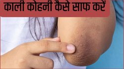 कोहनी और घुटनों का कालापन कैसे दूर करें? इस देसी उपाय से तुरंत हट जाएगा जिद्दी से जिद्दी मैल