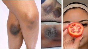 How To Remove Tan From Face, Neck, Hands, Knee | Home remedies for dark knees elbows and ankles | D-Tan Pack from Tomato