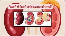 किडनी कैंसर होने पर बॉडी में दिखते हैं ये 5 लक्षण, तुरंत Symptoms को पहचानें तो खून का कतरा-कतरा रहेगा साफ़, गुर्दा सारे टॉक्सिन बॉडी से निकालेगा बाहर