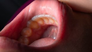 neem leaves for tooth decay