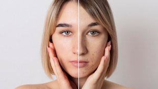 open pores on face, open pores , how to close pores permanently