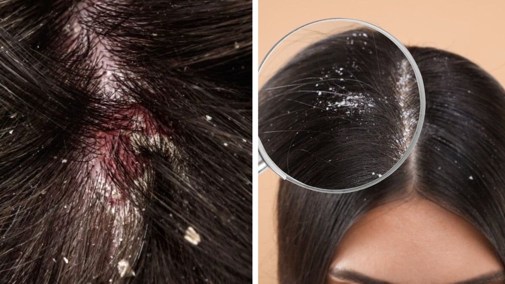 Scalp fungus treatment home remedies | Fungal infection on scalp | Scalp infection treatment
