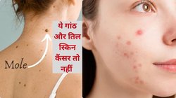 स्किन में बदलती गांठ या तिल हो सकते हैं Skin Cancer के संकेत, जानिए स्किन कैंसर की कैसे करें पहचान