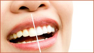 yellow teeth, get rid of yellow teeth, How Remove Cavities From Teeth