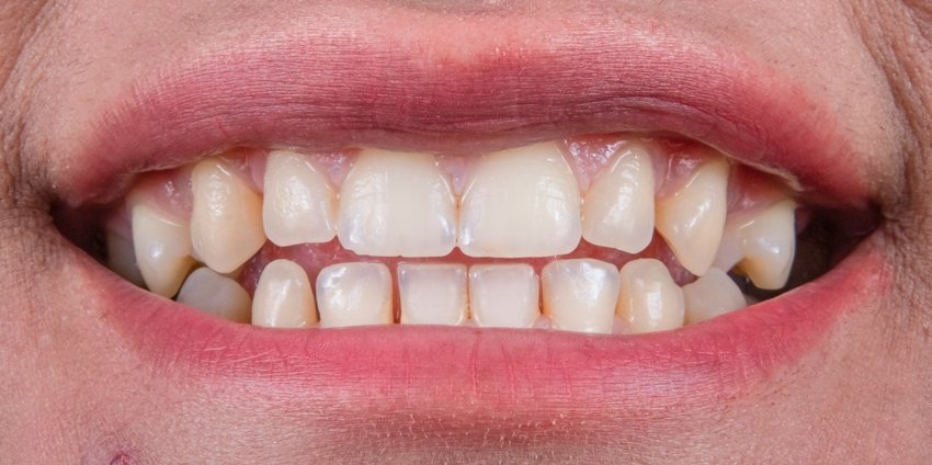30 Teeth Indicate Struggles