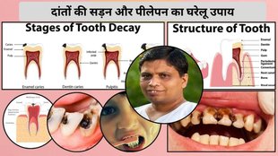 home remedies for yellow teeth, how to whiten teeth naturally, Acharya Balkrishna teeth whitening tips, Ayurvedic remedies for white teeth, natural teeth whitening at home
