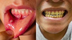 Best Ayurvedic remedy for oral problems