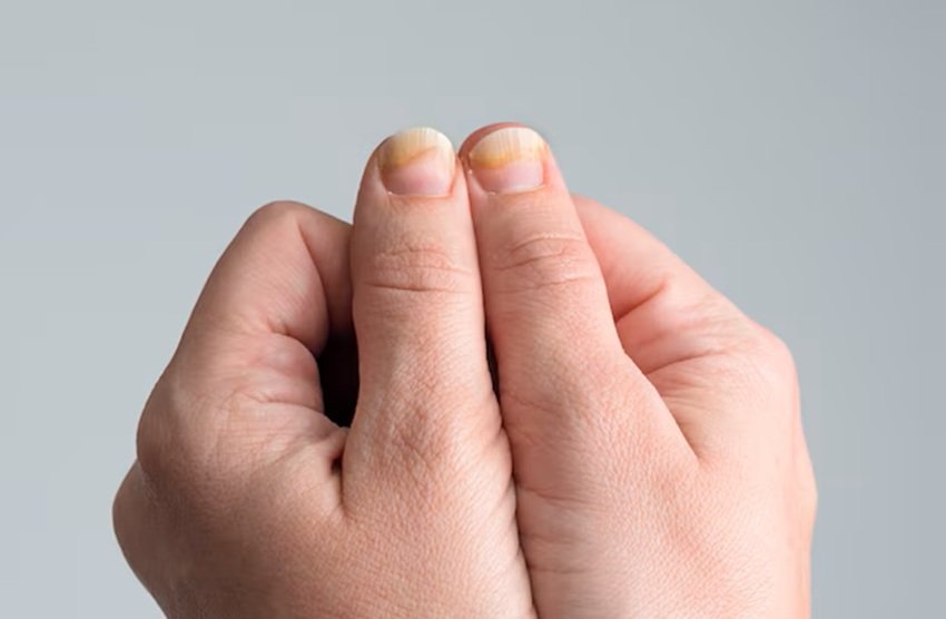 Causes of Yellow Nails and Simple Remedies