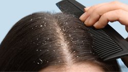 एंटी-डैंड्रफ शैंपू का इस्तेमाल करने के बाद भी नहीं जा रहा जिद्दी Dandruff, तो अपनाएं ये नुस्खे