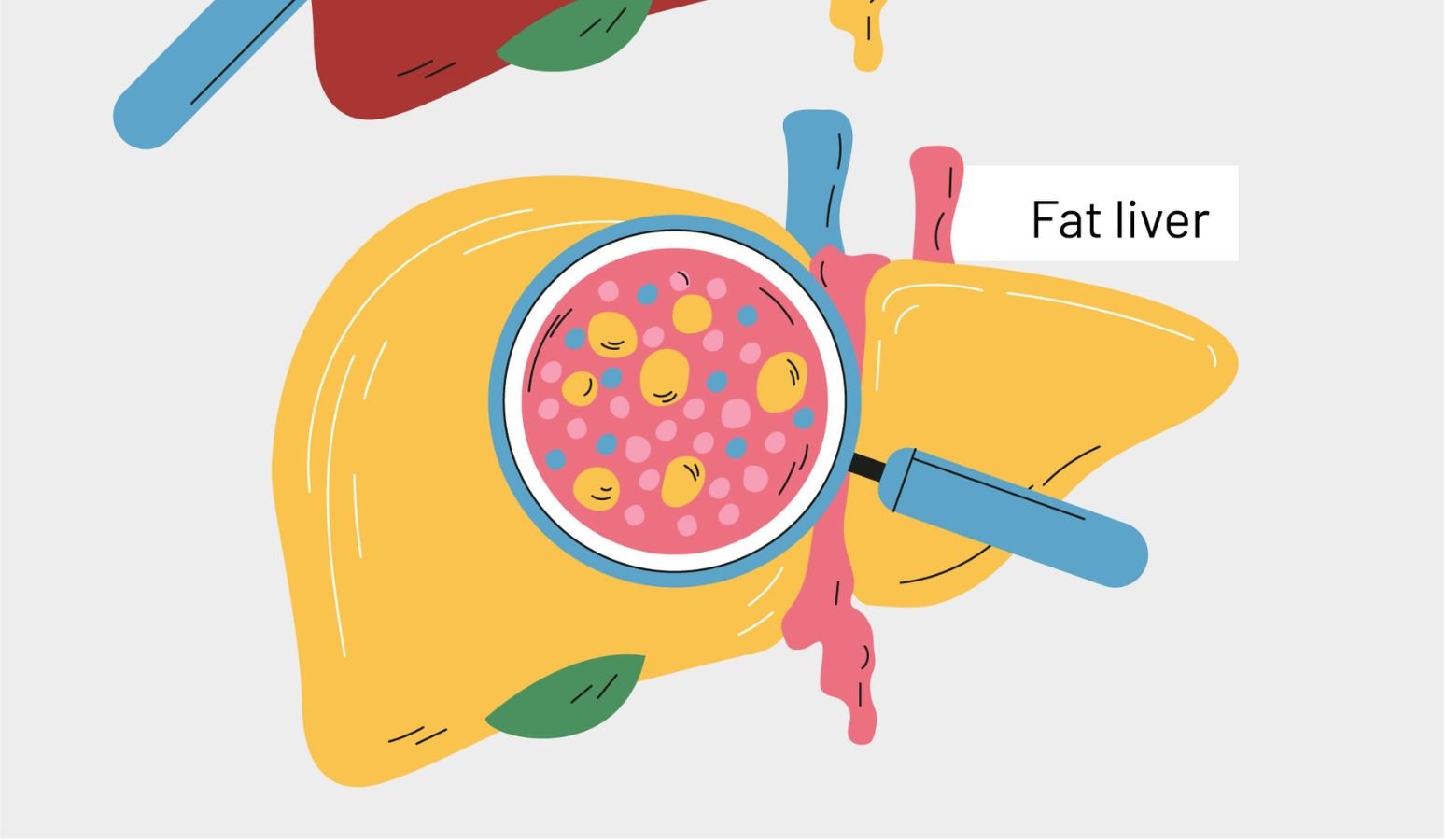 reverse fatty liver in 3 months