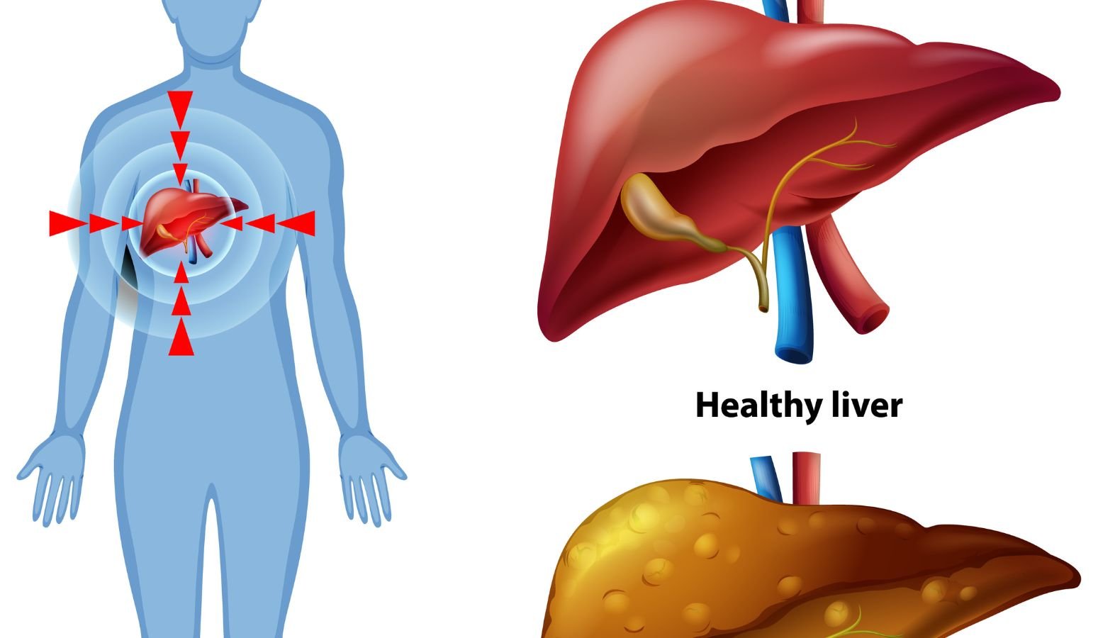 cure fatty liver naturally
