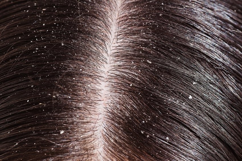 How Excess Sugar Harms Your Hair